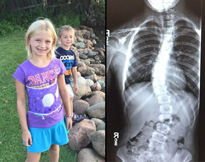 how-to-spot-signs-of-scoliosis-in-your-child